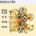 腰椎间盘突出症