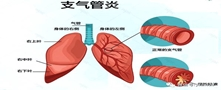 支气管炎